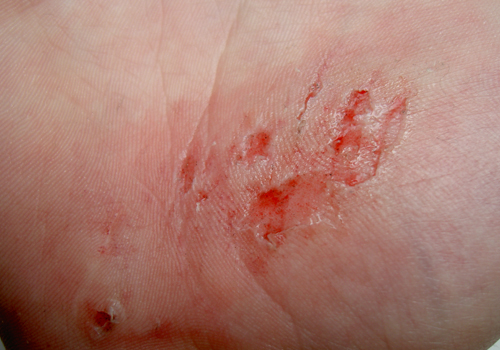 Cuts and abrasions